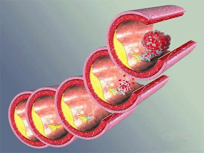 Ѫ֬��л������ʶ����Ѫ�ܼ���